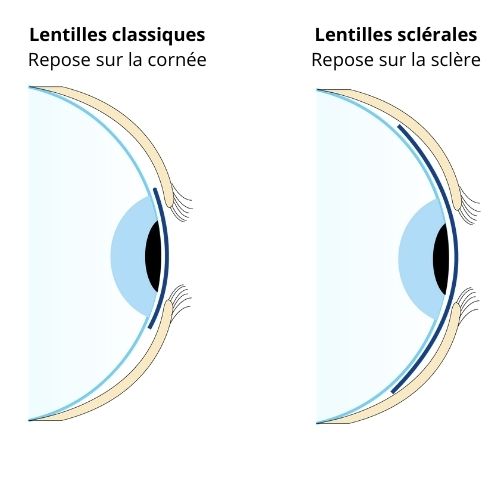 Lentilles sclérales