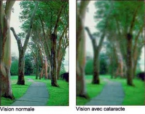 Cataracte Cataracte